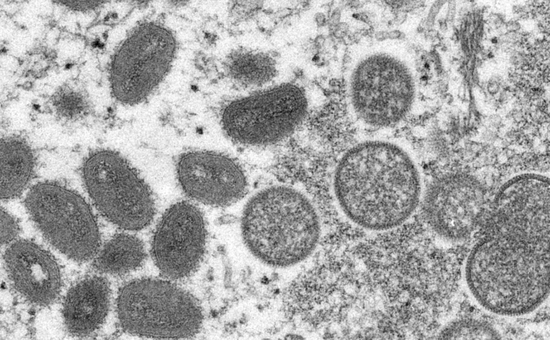 Deuxième cas suisse de variole du singe confirmé à Genève