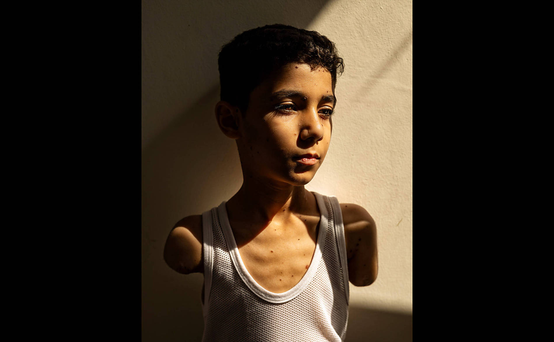 Portrait d'un enfant palestinien amputé primé au World Press Photo