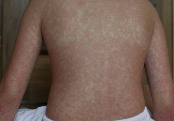 USA: l'épidémie de rougeole atteint un niveau jamais vu en 35 ans