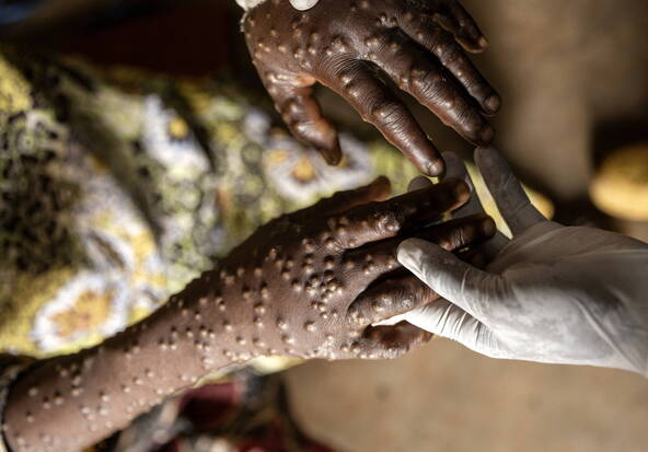 Mpox: de nombreux cas en RDC seraient de faux diagnostics (UNIGE)
