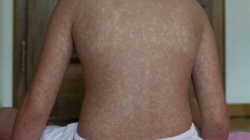 USA: l'épidémie de rougeole atteint un niveau jamais vu en 35 ans