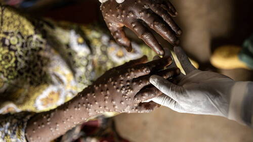 Mpox: de nombreux cas en RDC seraient de faux diagnostics (UNIGE)