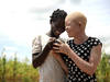 Burundi: un enfant albinos retrouvé mort et démembré