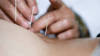 Acupuncture et homéopathie continueront d'être remboursées