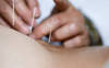 Acupuncture et homéopathie continueront d'être remboursées