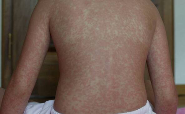 USA: l'épidémie de rougeole atteint un niveau jamais vu en 35 ans