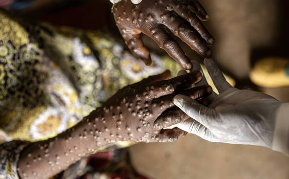 Mpox: de nombreux cas en RDC seraient de faux diagnostics (UNIGE)
